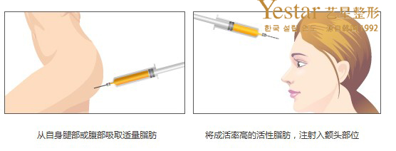 自体脂肪丰额头