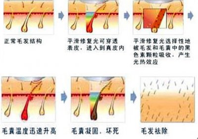 腋下脱毛