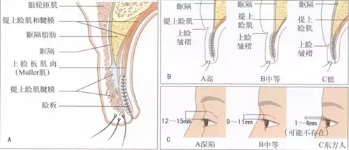 双眼皮