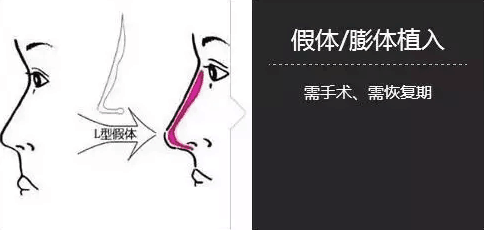 北京隆鼻假体好还是好?