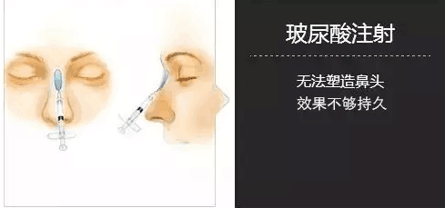 北京隆鼻有哪些方法