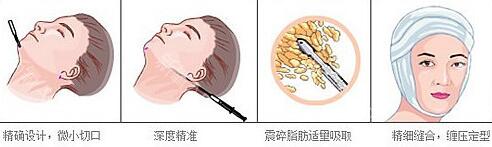 面部吸脂