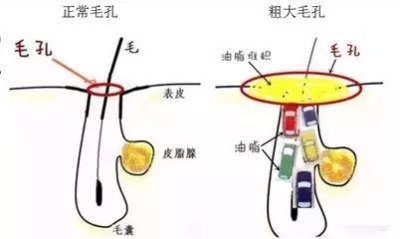 毛孔粗大和黑头形成的原因-如何去除