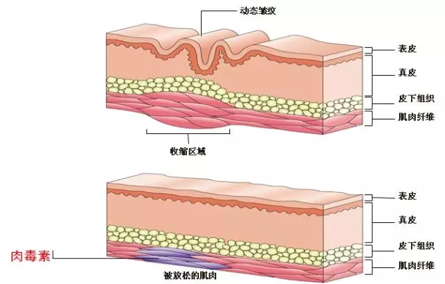 的除皱原理