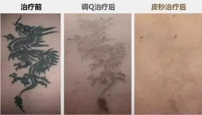 皮秒去纹身前后对比图