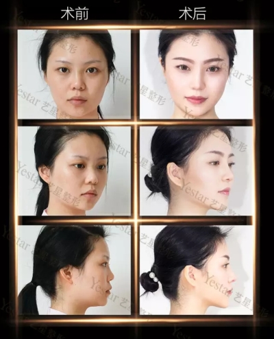 隆鼻前后对比图
