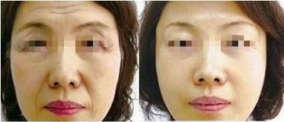 一次轻松祛皱,面部除皱费用