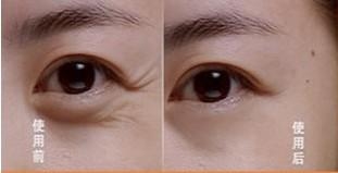 一次轻松祛皱,面部除皱费用